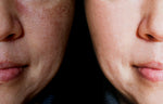 Pores dilatés, hyperpigmentation et cellulite; comprendre les différentes conditions de la peau